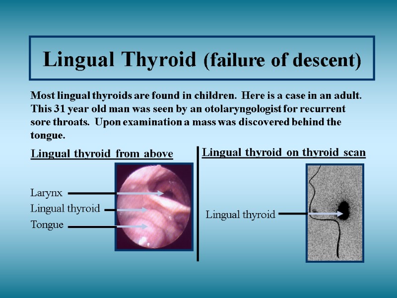 Lingual Thyroid (failure of descent)